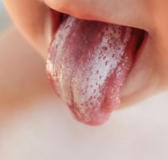 Candida Orale: come riconoscerla, prevenirla e curarla in modo efficace