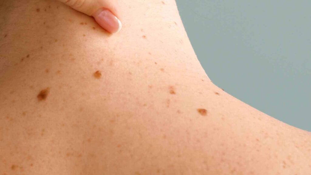 Dermatosi Papulosa Nigra: cos'è, come riconoscerla e trattarla in sicurezza