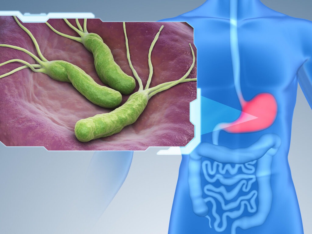 Helicobacter Pylori
