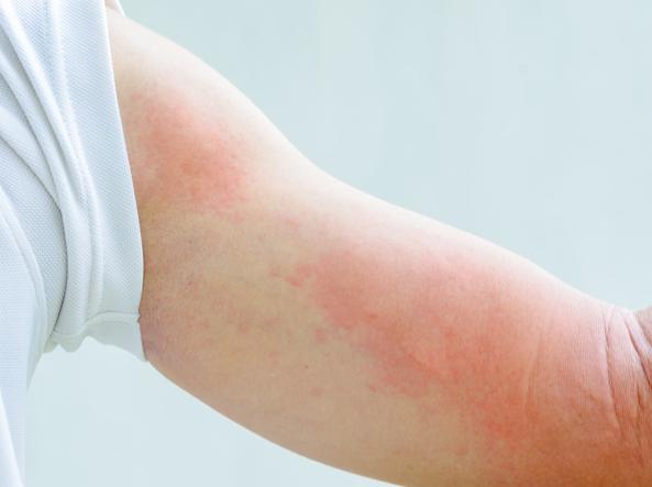 Allergie agli antibiotici: cosa sono e come riconoscerle