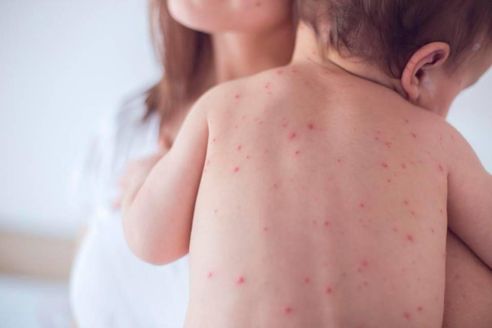 Morbillo: perché stà tornando e come proteggere i più piccoli