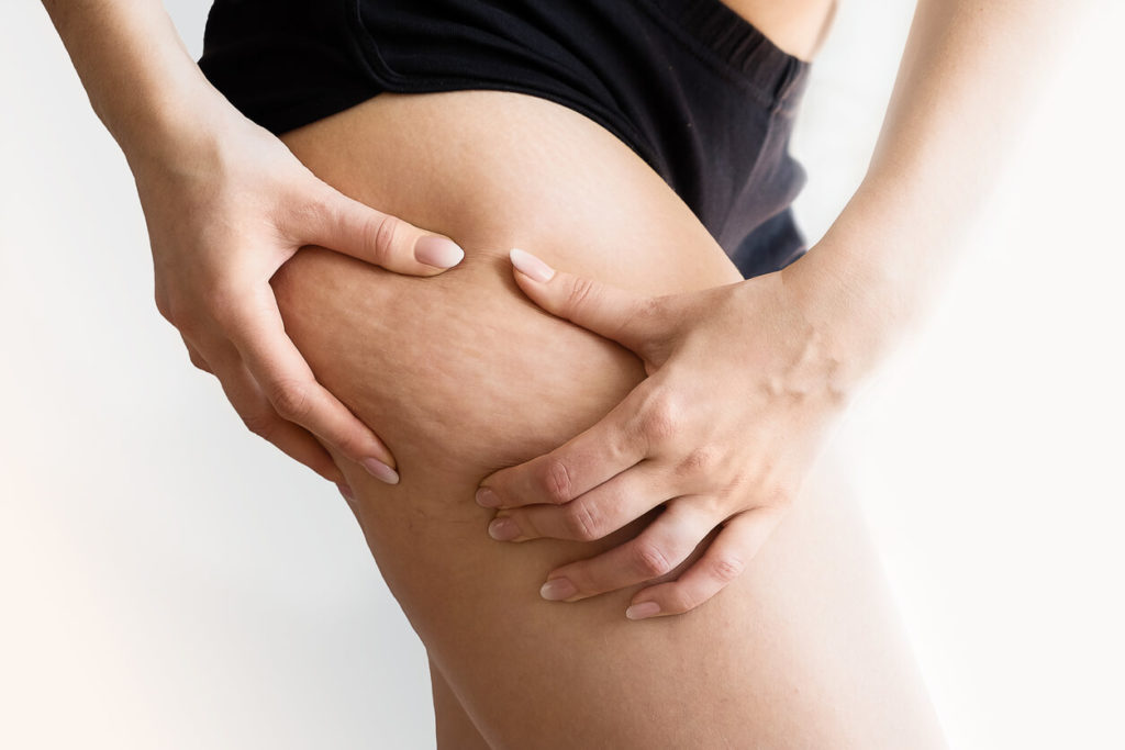 Cellulite: Sveliamo il mistero della “pelle a buccia d’arancia”