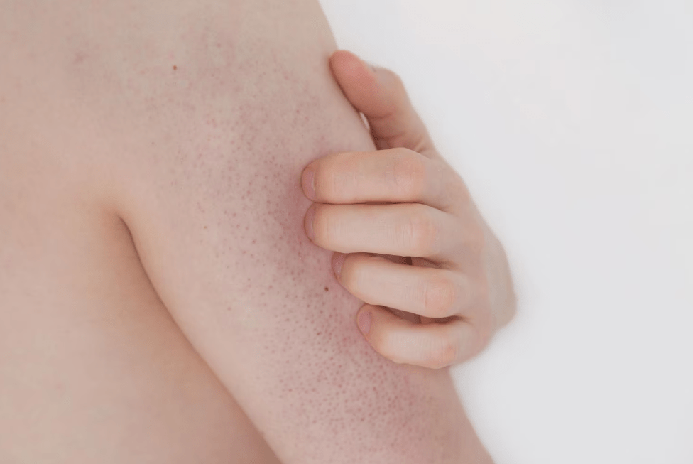 Cheratosi pilare: come trattarla (e prevenirla) con costanza e prodotti giusti