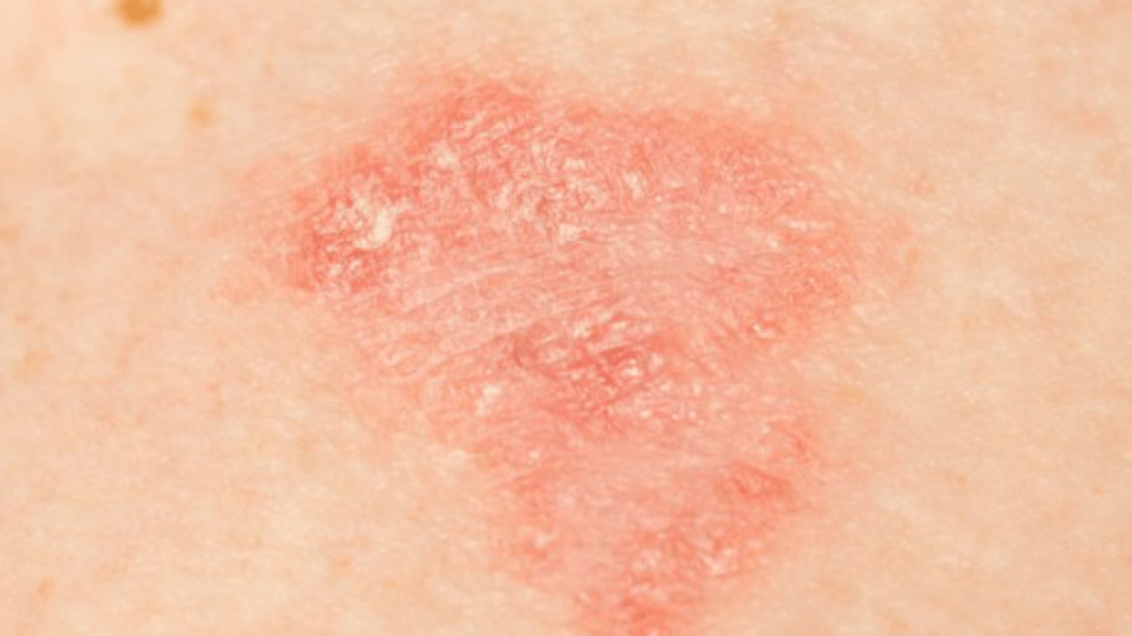 Dermatite atopica: la cura per gli adulti e per i bambini