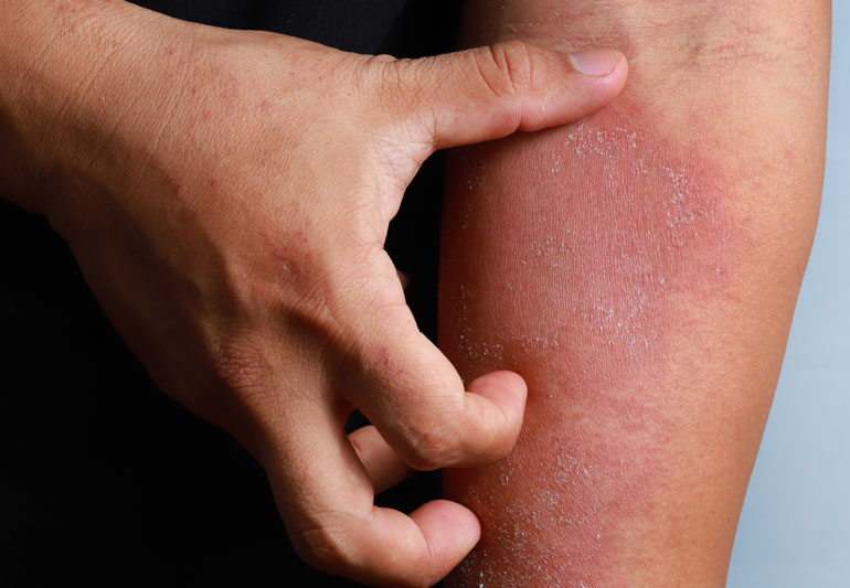 Eczema: la Guida Completa per Conoscere e Gestire la Dermatite