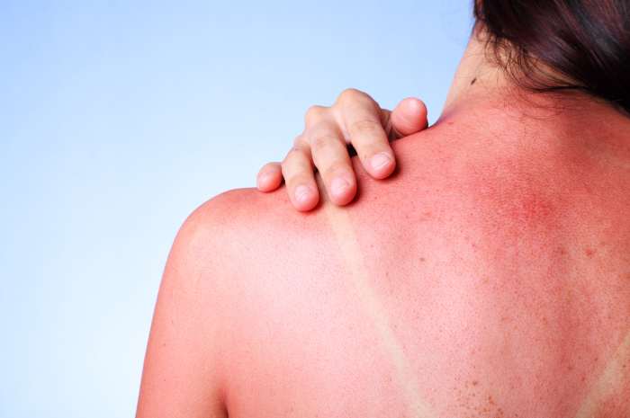 Sole e Pelle: Comprendere l’Eritema Solare