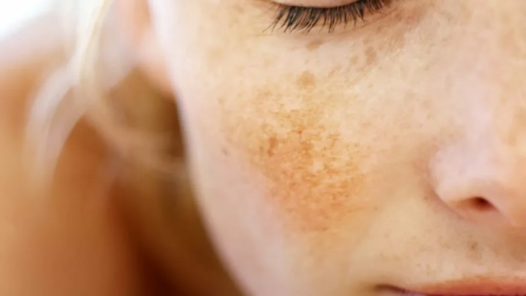 Melasma in gravidanza: perché compare e come prevenirlo in modo sicuro