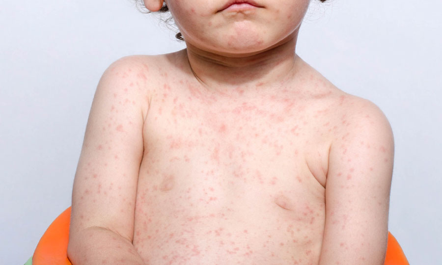 Cos’è la Sesta Malattia: sintomi, cause, e come prevenirla