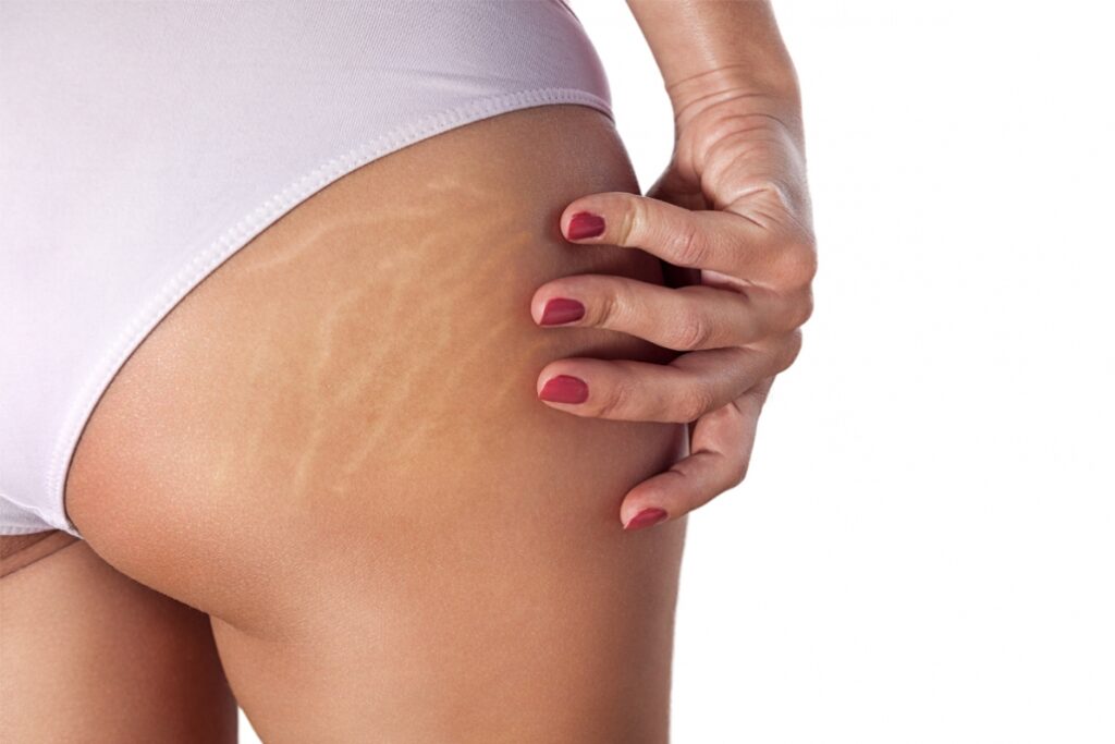 Smagliature: L’invisibile Nemico di Bellezza – Scopriamo Come Combatterle
