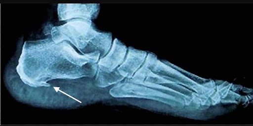 La Spina Calcaneare: Un Approfondimento Completo